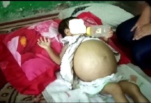 Perutnya Membesar, Bayi 10 Bulan di Talang Padang Tanggamus Butuh Uluran Tangan