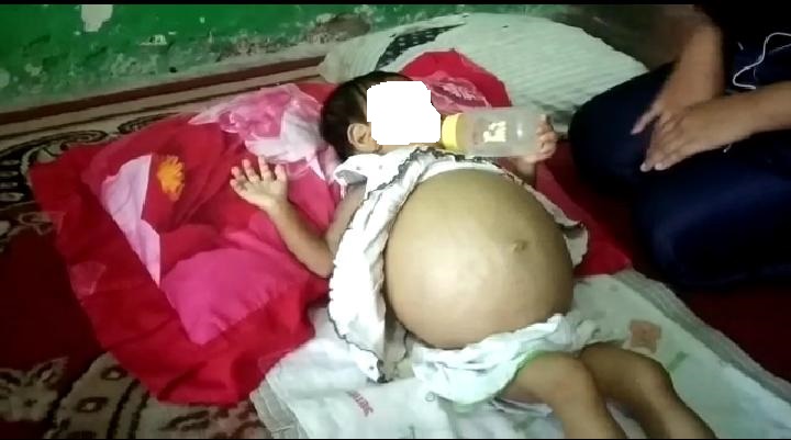 Perutnya Membesar, Bayi 10 Bulan di Talang Padang Tanggamus Butuh Uluran Tangan